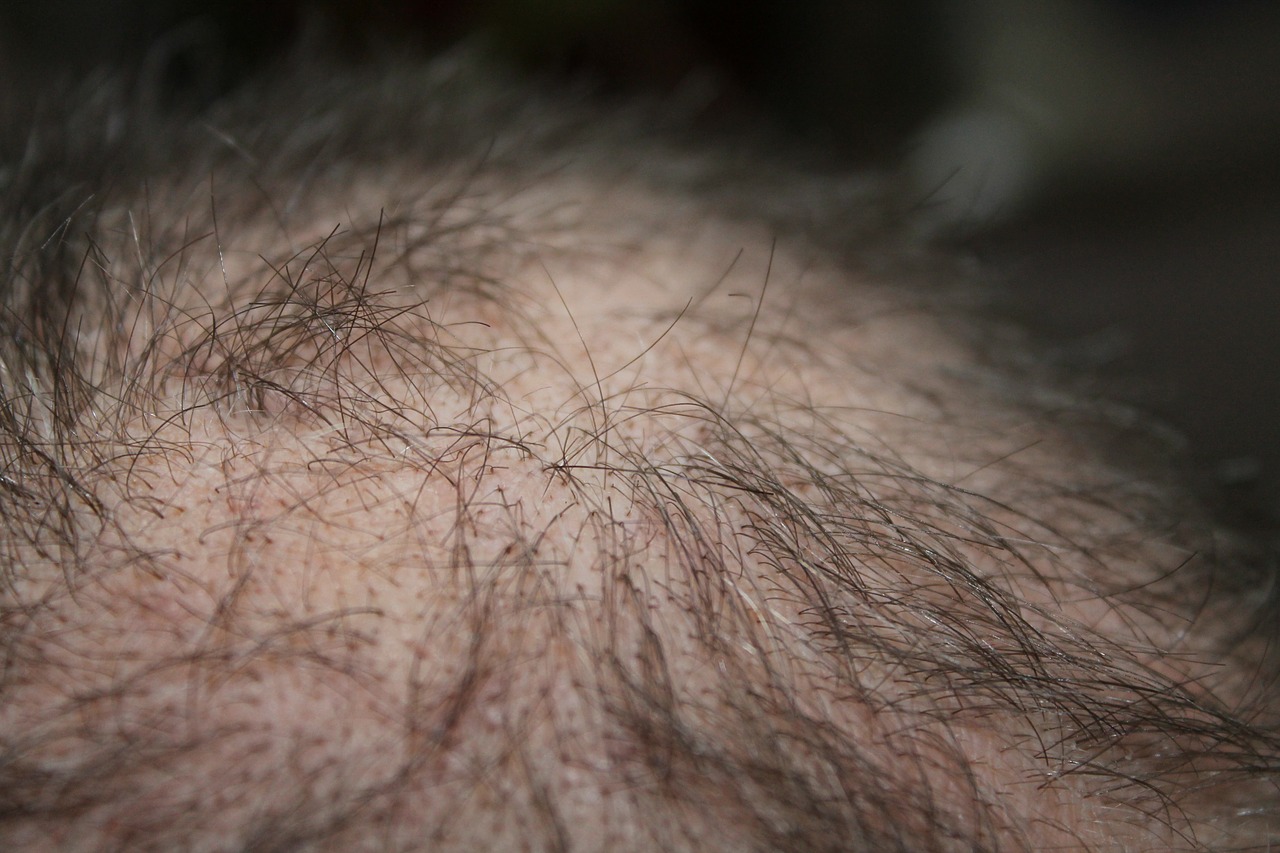 Haarausfall – Arten und Symptome