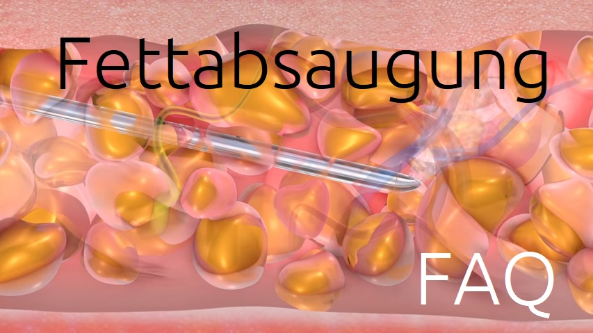 Fettabsaugen- Liposuktion-FAQ