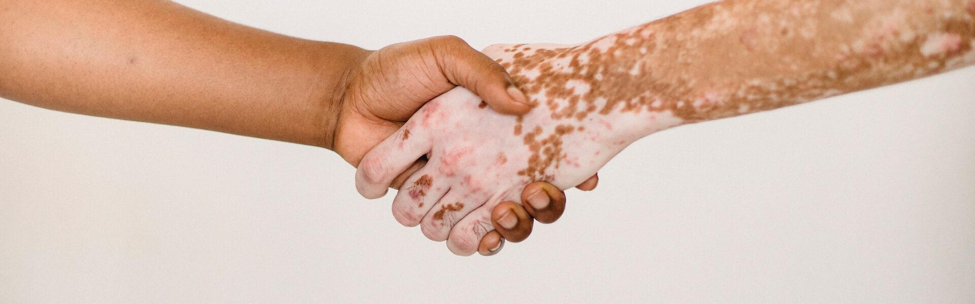 Was ist Vitiligo - Symptome & Ursachen
