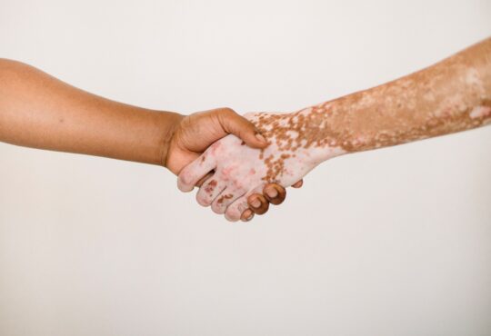 Was ist Vitiligo - Symptome & Ursachen